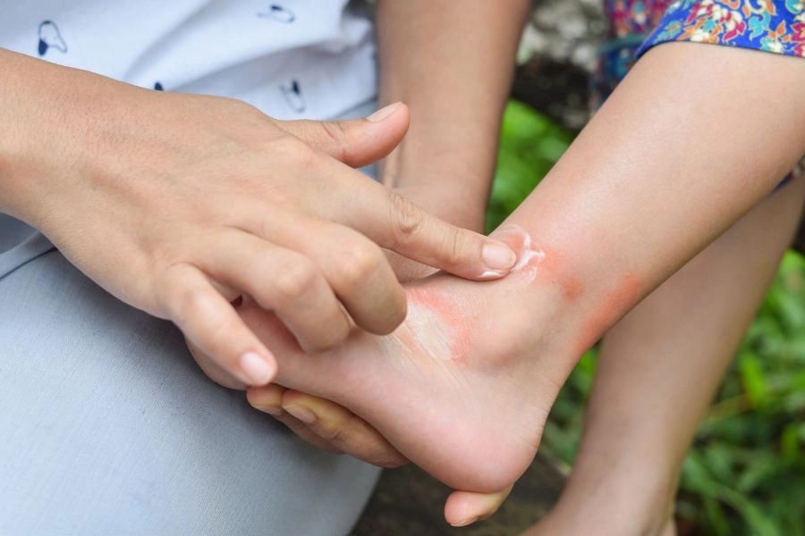 Adult treating mosquito bites on child's leg